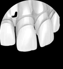 Установка ультраниров